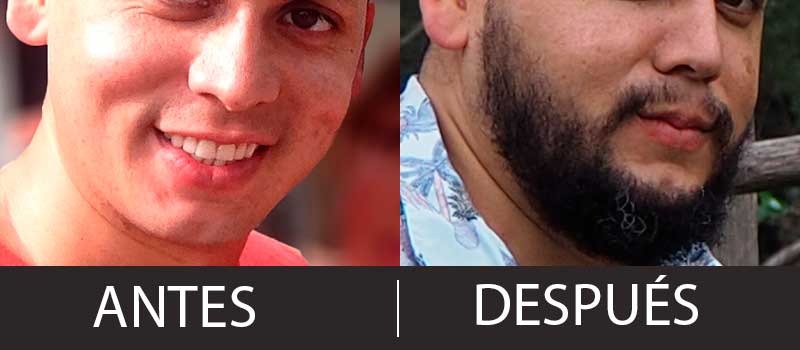 Minoxidil antes despues